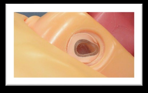 ずれが生じた気管切開口