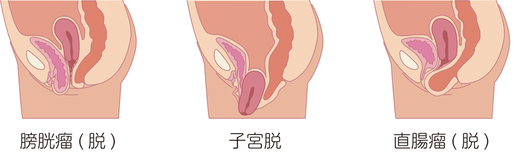 脱3種説明