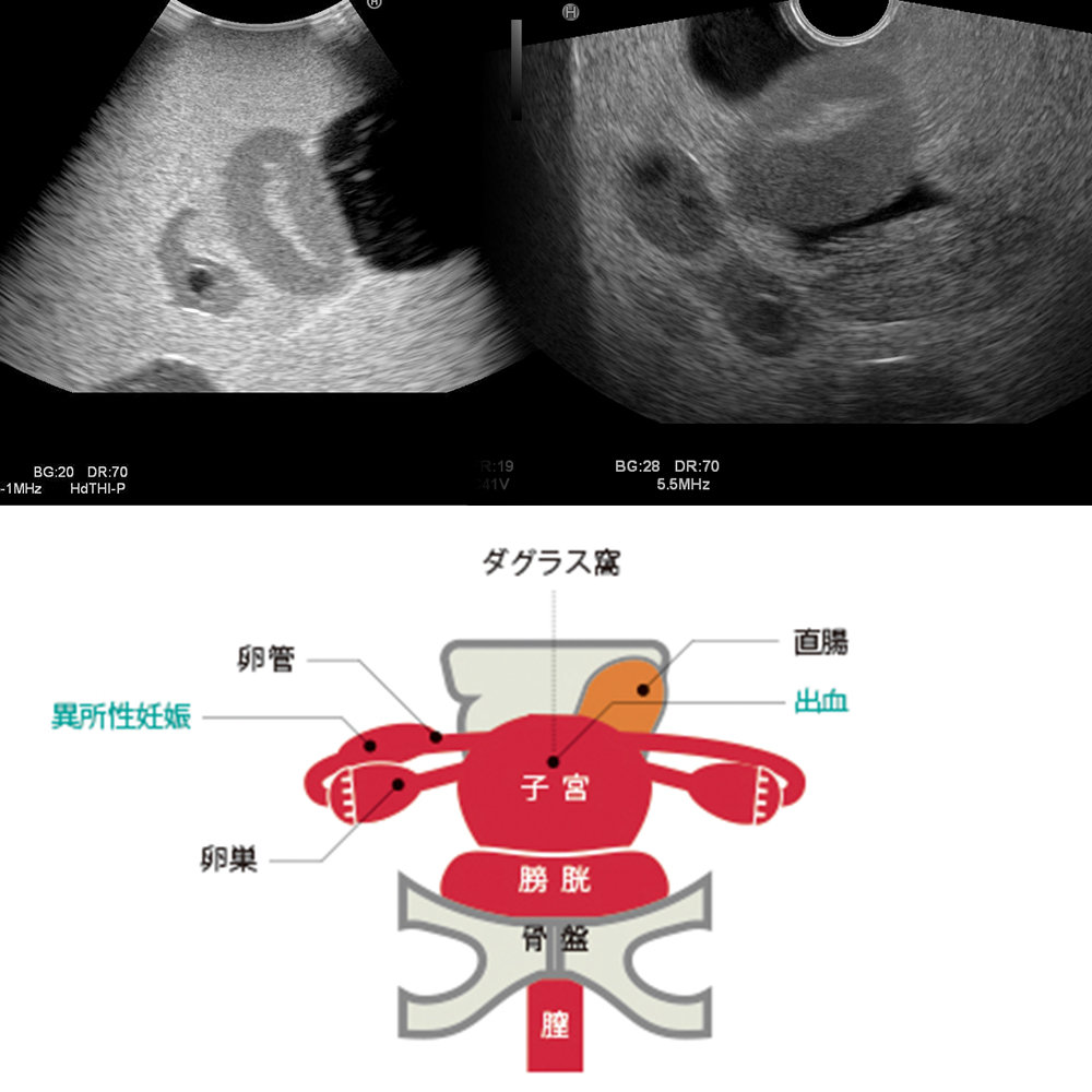 婦人科超音波診断ファントム　3種セット（正常妊娠7週ユニット・病変ユニットⅡ・異所性妊娠ユニットⅡ）