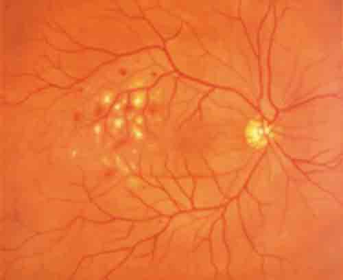 Simple Background Diabetic Retinopathy Fundus Photo