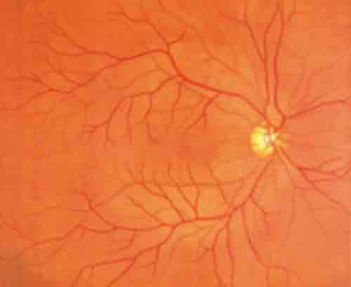 Normal Fundus Photo