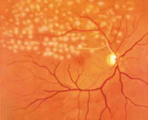Post Retinal Laser Photocoagulation Fundus Photo