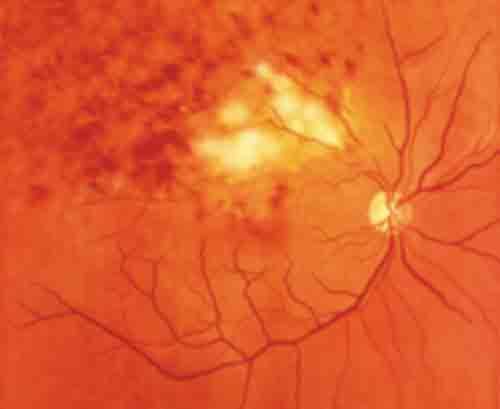 Retinal Vein Occlusion Fundus Photo